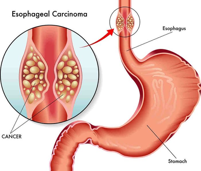 Trong nhiều trường hợp, polyp thực quản có thể tiến triển thành ung thư