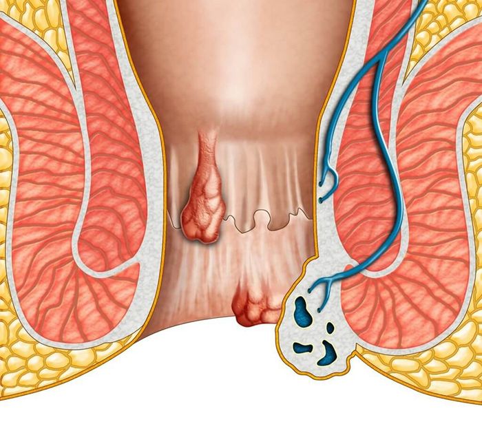 Bệnh trĩ là một căn bệnh khá phổ biến ngày nay, gây khó chịu cho nhiều người vì vị trí xuất hiện ở vùng nhạy cảm trên cơ thể.