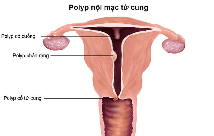 Polyp tử cung hình thành do sự phát triển của các tuyến hoặc mô tế bào đệm nội mạc tử cung