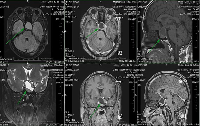 Việc phát hiện u tuyến yên có thể thông qua việc thực hiện chụp MRI