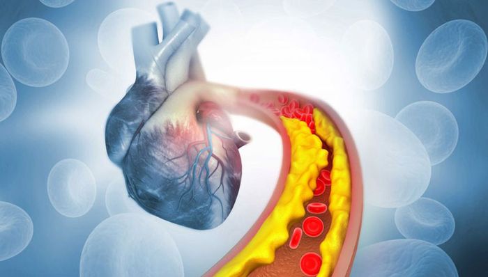 Rối loạn lipid máu có thể gây ra <a href='https://medlatec.vn/tin-tuc/dot-quy-la-gi-nguyen-nhan-va-dau-hieu-cua-benh-nhu-the-nao-s195-n18170'  title ='đột quỵ'>đột quỵ</a>