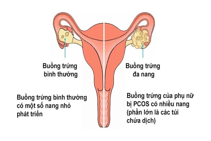 Buồng trứng đa nang là nguyên nhân gây rụng tóc