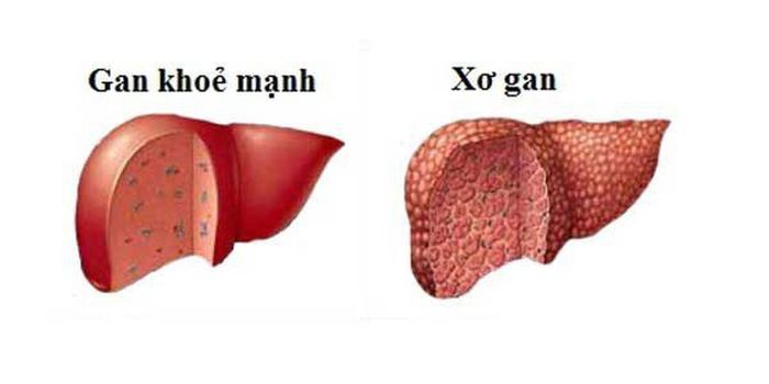 Người mắc bệnh liên quan đến đường mật, như nhiễm trùng hoặc dịch ứ đọng.