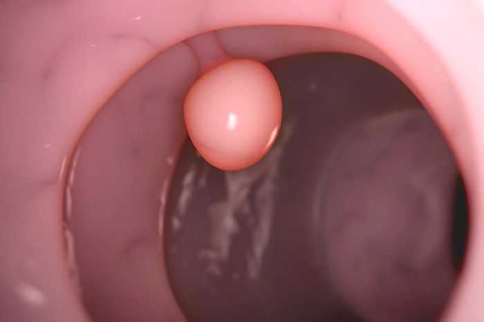 Minh hoạ về polyp trong cơ thể