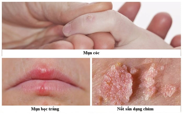 Dấu hiệu của viêm nhiễm HPV nguy cơ thấp thường là những mụn cóc sinh dục.