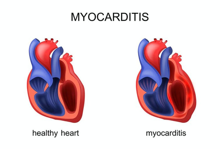 Thực tế, có rất nhiều nguyên nhân gây bệnh viêm cơ tim.