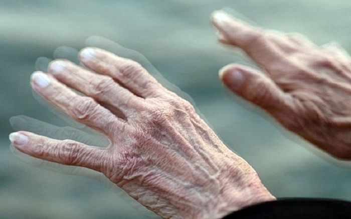 Người mắc bệnh Parkinson thường gặp khó khăn trong vận động, đặc biệt là run mạnh ở đầu ngón tay