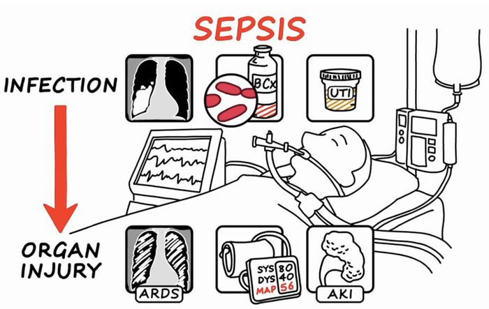 Nguy cơ tử vong cao xuất phát từ sốc nhiễm khuẩn
