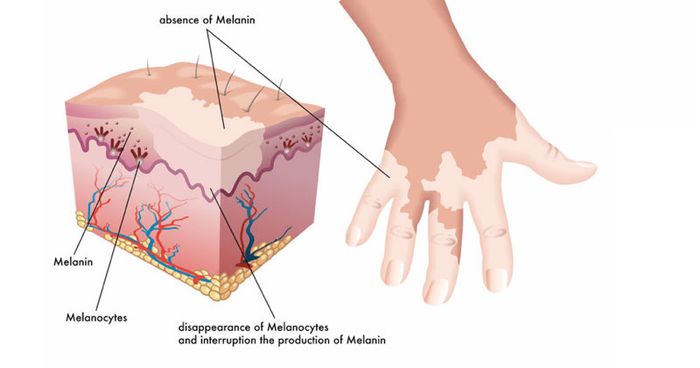 Bạch biến là một bệnh da liễu liên quan đến việc hủy hoại các tế bào sắc tố da