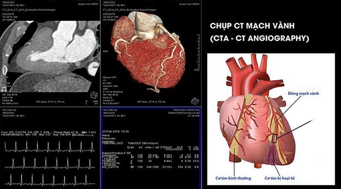 Chụp CT mạch vành là phương pháp hiện đại để chẩn đoán các vấn đề liên quan đến đau ở vùng ngực bên trái