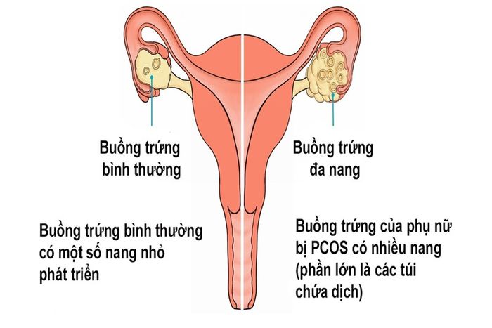 Bệnh buồng trứng đa nang