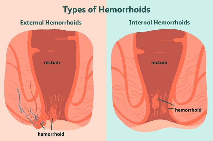 Hai loại trĩ phổ biến là trĩ nội và trĩ ngoại.