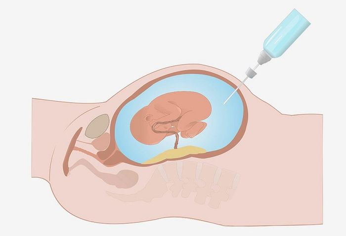 Phương pháp chọc ối giúp chẩn đoán thalassemia trước khi sinh