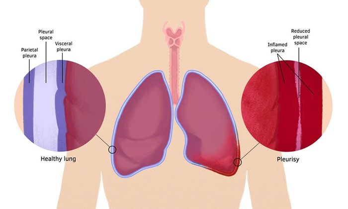 Bệnh gây cản trở quá trình hô hấp