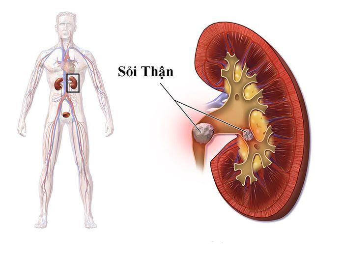 Sỏi thận có thể là một trong những nguyên nhân gây suy giảm chức năng thận