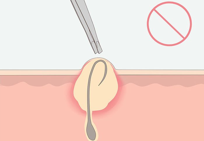 Nhổ lông nách thường xuyên khiến nang lông mở rộng, tiết mồ hôi nhiều hơn