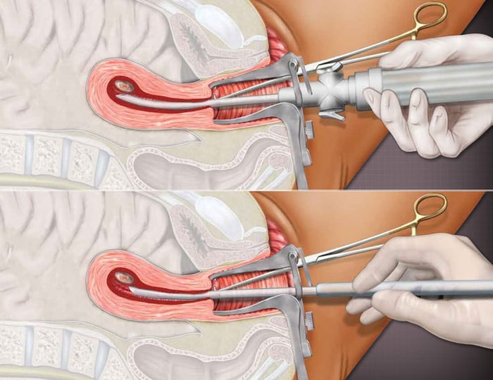 Phá thai là hành động kết thúc thai kỳ bằng cách loại bỏ phôi thai hoặc lấy thai nhi ra khỏi tử cung