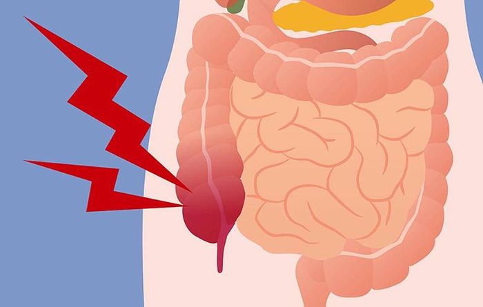 Viêm ruột thừa có thể gây ra những biến chứng nguy hiểm