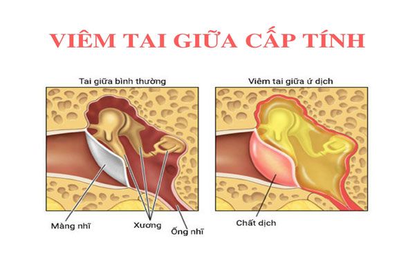 Nhiều nguyên nhân có thể dẫn đến viêm tai giữa cấp tính