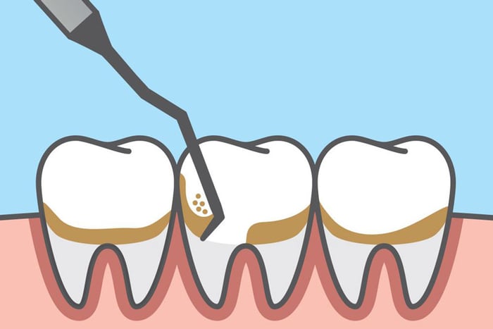 Nên đi khám nếu bạn bị sưng lợi.