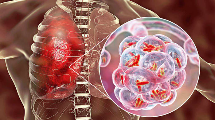 Bệnh lao màng phổi là một loại phổ biến của lao ngoài phổi do vi khuẩn Mycobacterium Tuberculosis gây ra.