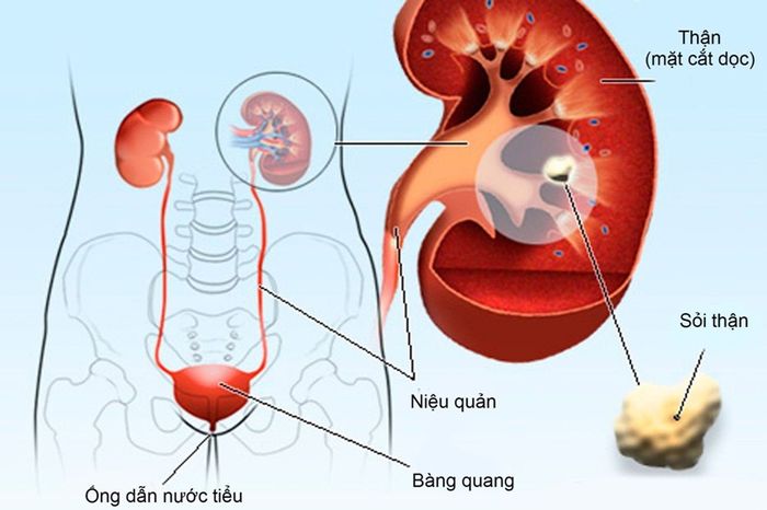 Sỏi thận là một trong những nguyên nhân gây ra tình trạng tiểu nhiều lần