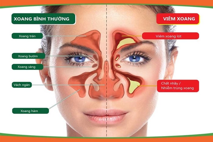 Bệnh viêm xoang là một thách thức trong việc điều trị