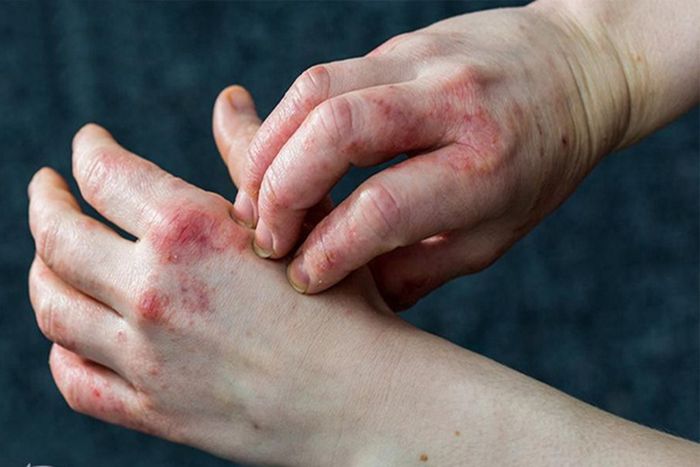 Eczema là một vấn đề da dị ứng phổ biến, làm viêm da và gây khó chịu. Mặc dù không gây nguy hiểm cho tính mạng, nhưng bệnh lại gây ảnh hưởng đến tâm trạng và tự tin của người mắc phải.