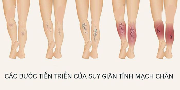 Các giai đoạn của bệnh suy giãn tĩnh mạch