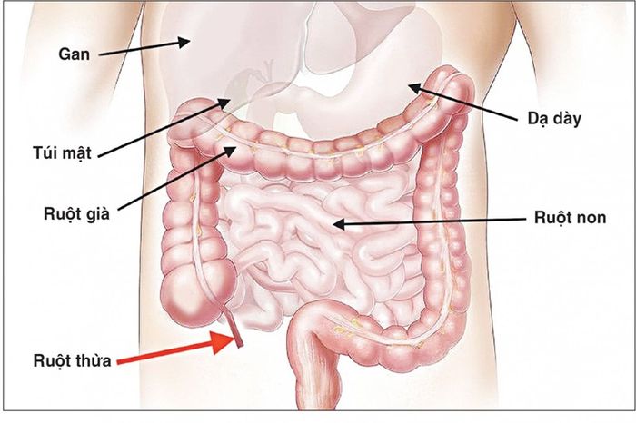 Viêm ruột thừa có thể gây ra cơn đau bụng bên phải