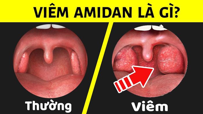 Các dấu hiệu cho thấy bạn đang mắc viêm amidan