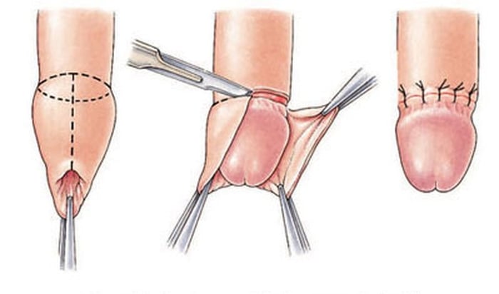 Trường hợp hẹp bao quy đầu không được cải thiện sau điều trị tại nhà có thể cần phải thực hiện can thiệp phẫu thuật.