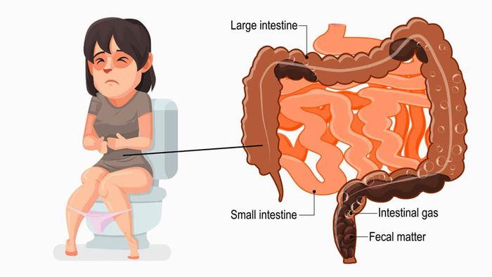 Tình trạng táo bón kéo dài gây áp lực lên tĩnh mạch hậu môn.