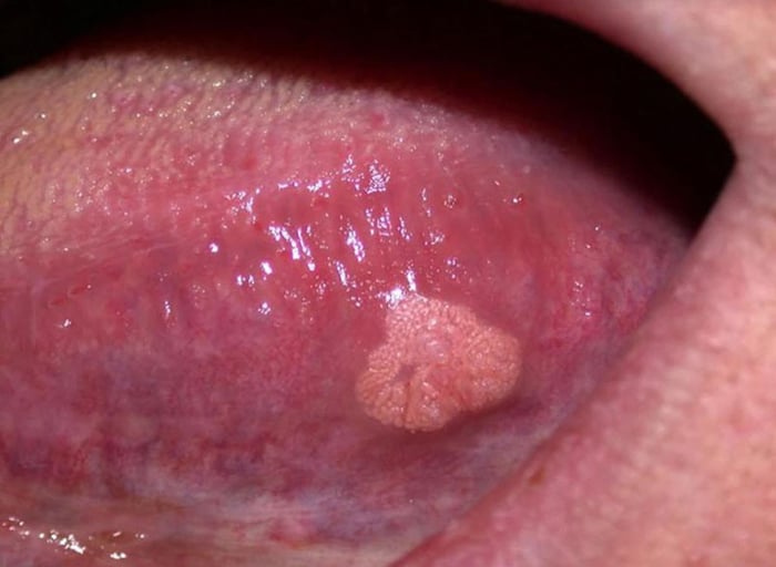 Thói quen quan hệ tình dục bằng miệng có thể tăng nguy cơ lây nhiễm virus HPV