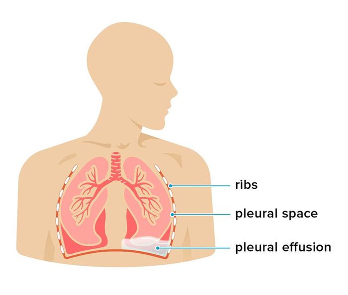 Tràn dịch màng phổi là hiện tượng dịch tích tụ trong khoang màng phổi