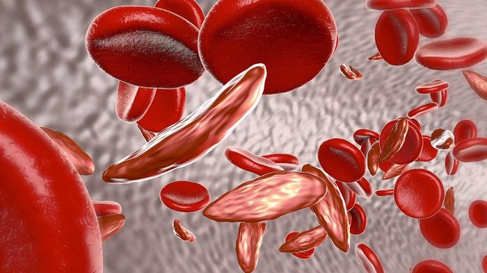 Thalassemia khi không được điều trị có thể đe dọa tính mạng.