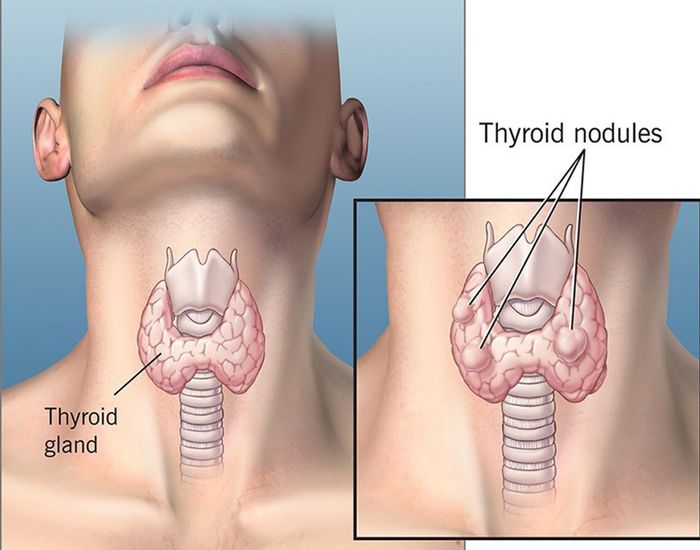 Nhân tuyến giáp là hiện tượng xuất hiện nhân bên trong tuyến giáp