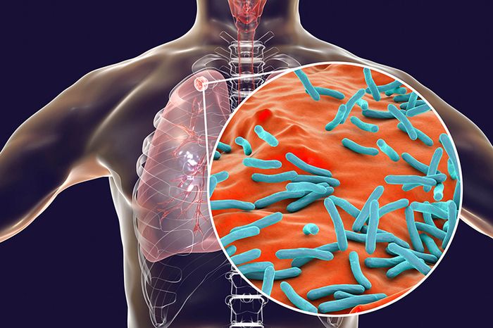 Mycobacterium Tuberculosis là nguyên nhân chính gây ra bệnh lao màng phổi