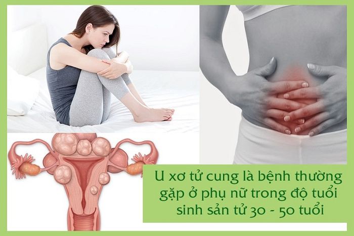 Người mắc u xơ tử cung thường phải chịu đựng đau ở vùng bụng dưới