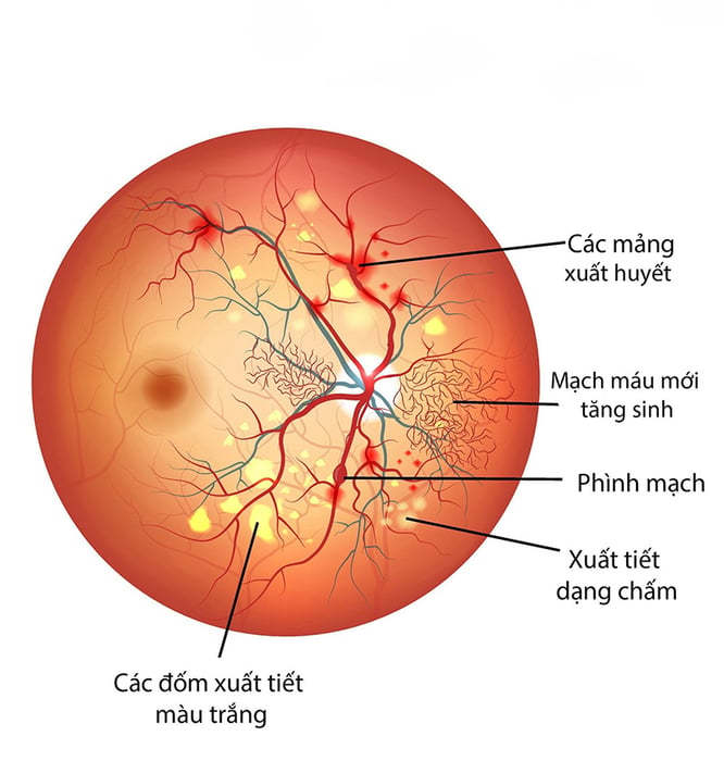 vấn đề về huyết áp cao