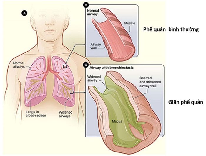 Minh họa sự khác biệt giữa ống khí bình thường và ống khí bị tắc nghẽn