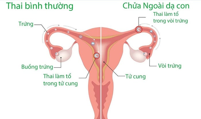 Một số trường hợp mang thai ngoài tử cung có thể dẫn đến kết quả xét nghiệm beta hCG giảm.