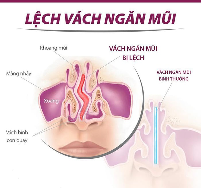 Lệch vách ngăn mũi có thể gây ra nghẹt mũi