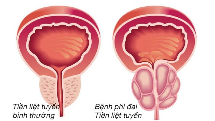 tuyến tiền liệt