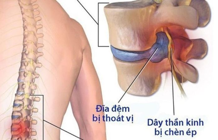 Vấn đề về thoát vị đĩa đệm