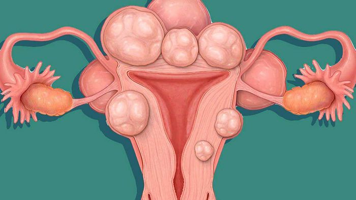 Khối u xơ phát triển ở nhiều vị trí khác nhau trên tử cung