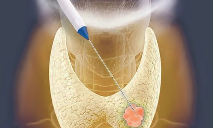 Việc điều trị u tuyến giáp bằng sóng cao tần ít xâm lấn và rất an toàn.