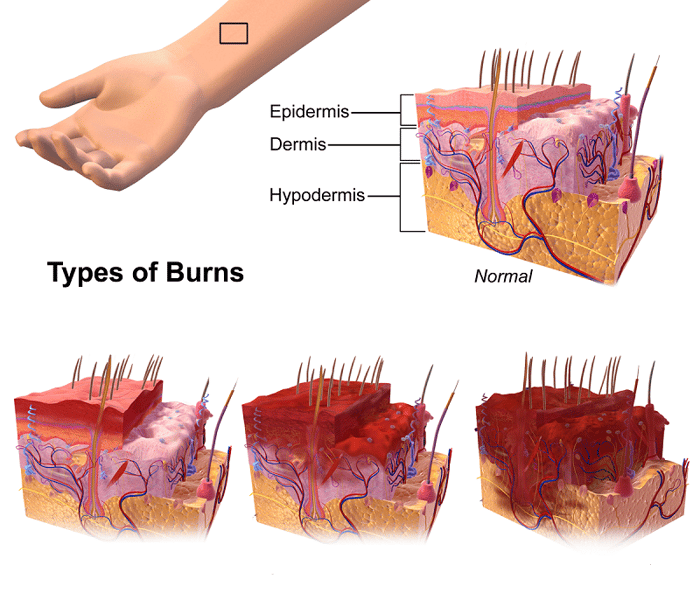 Biểu đồ miêu tả da bình thường và ba mức độ tổn thương khi bị bỏng