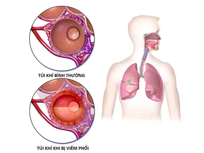 Khó thở là triệu chứng của bệnh gì