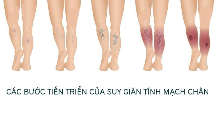 Dấu hiệu phát triển của bệnh giãn tĩnh mạch chân